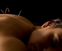 Sonoma acupuncture